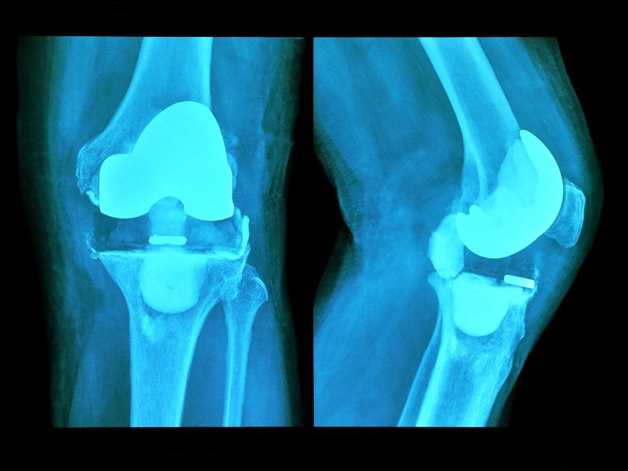 Radiografia che mostra una protesi al ginocchio usurata che necessita di revisione